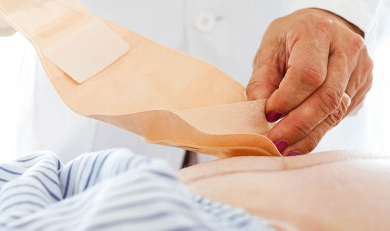 Stoma Care